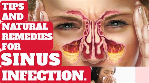 Tips And Natural Remedies How To Treat Sinus Infection. - YouTube
