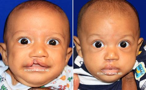 Cleft Lip And Palate Surgery, NJ | Dr. Robert Morin