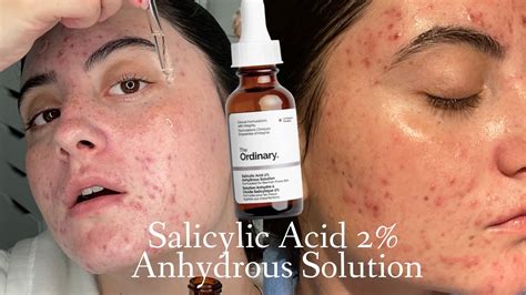 TESTING THE ORDINARY SALICYLIC ACID 2% ANYDROUS SOLUTION FOR 3 WEEKS ON HORMONAL ACNE SKIN - YouTube