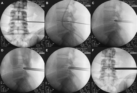 Transforaminal percutaneous endoscopic discectomy. Fluoroscopic ...