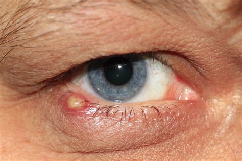 Eyelid Fungal Infection