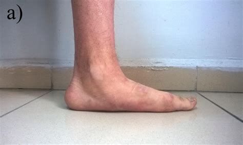 Symptomatic flexible flatfoot in adults: subtalar arthroereisis | TCRM