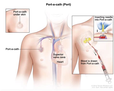 I Love My Port-A-Cath | Cancer's A Bitch Blog