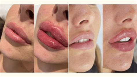 Russian Lip Filler Technique vs Normal What's The Difference? - the daily glimmer