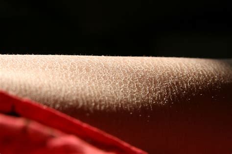 Skin care Tips for those with Dry Skin (Preventative) - Battle Eczema