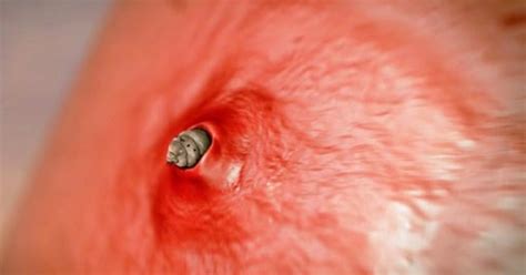 Botfly - One Nasty Bug You Don't Want to Meet in a Dark Alley - CBS News