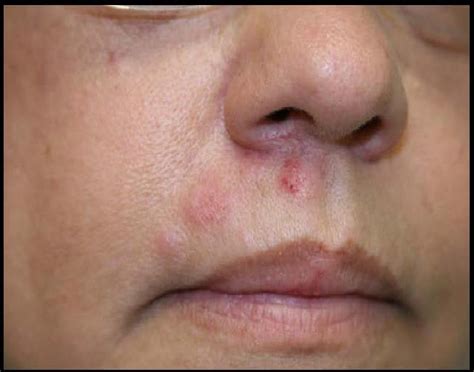 Herpes Rash On Face Pictures - Goimages Inc