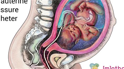 Fetal Monitoring - Intrauterine Pressure Catheter (IUPC) - YouTube