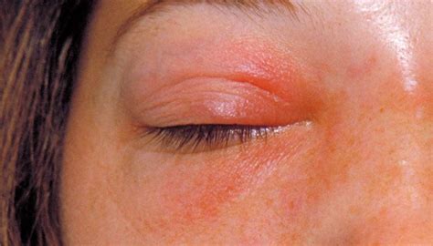 Preseptal Cellulitis Vs Orbital Cellulitis