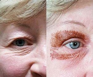 Excellent before and after pics of a lady whose eyelids, upper and lower have just been ...