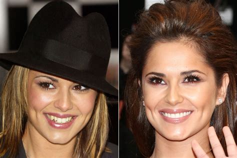 Celebrities With Bad Veneers