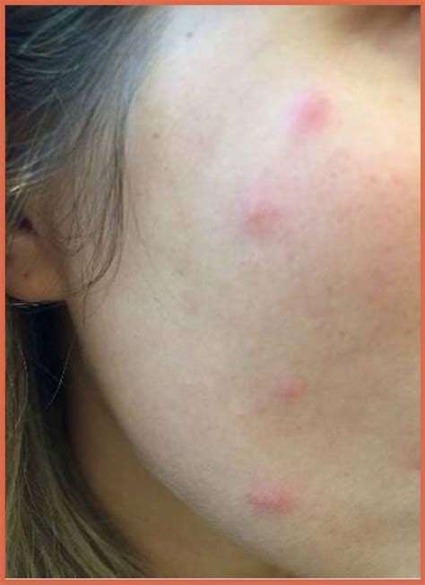 Pictures Of Bed Bug Bites On Face - Bed Bugs Pics