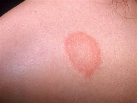 Ringworm, tinea, causes, signs, symptoms, diagnosis & treatment