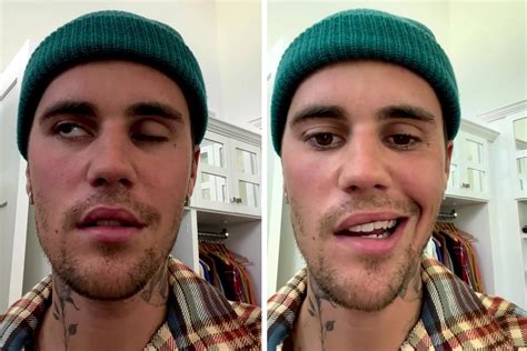 What happened to Justin Bieber's face - Facial Paralysis — Kassir ...