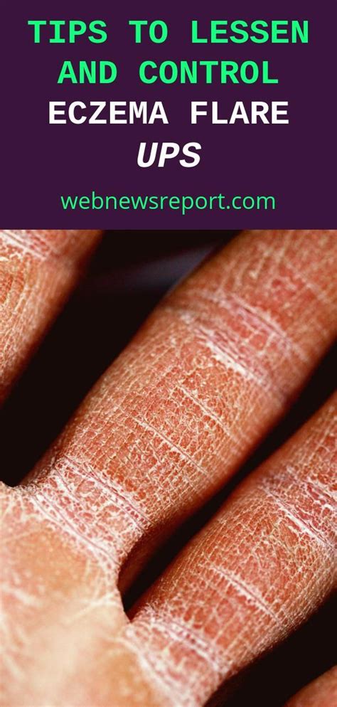 Tips to Lessen and Control Eczema Flare Ups - Web News Report in 2021 ...