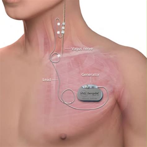 Vagus nerve stimulation implant praised by depression patient - BBC News