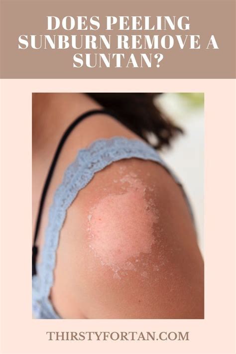 Does Peeling Sunburn Remove A Suntan? (Explained) | Sunburn skin peeling, Sunburn peeling, Face ...