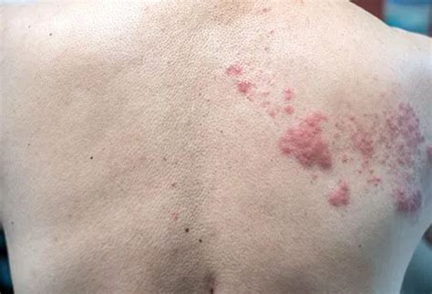 What Does a Shingles Rash Look Like at First? - Okkii.com