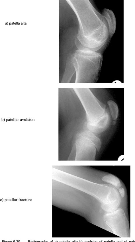 Severe crouch gait in the sagittal gait patterns of spastic diplegic ...