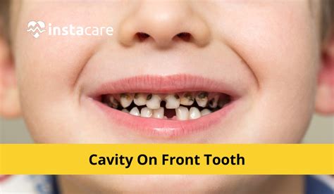 Teeth With Cavities 6 Symptoms And Causes 2024 - vrogue.co