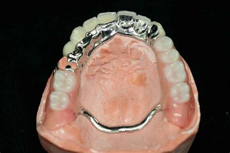 Upper Partial Denture