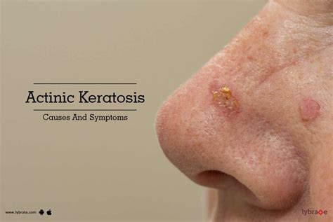 Actinic Keratosis: Causes And Symptoms - By Dr. Amitoj Garg | Lybrate