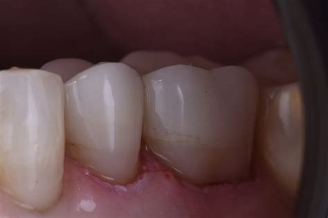 Protecting cervical abrasion on previously crowned teeth