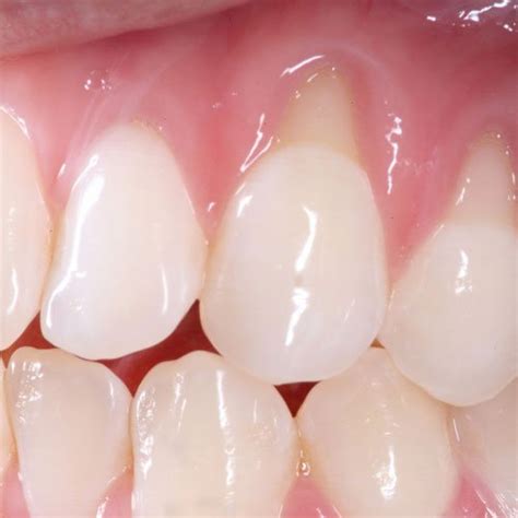 Receding gums causes and treatment options | Kowhai Dental