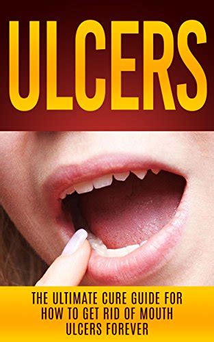 Ulcers: The Ultimate Cure Guide for How to Get Rid of Mouth Ulcers Instantly (Ulcer Free, Ulcer ...