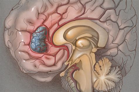 Trial tests treatment for John McCain's type of cancer | MUSC Research