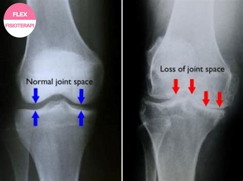 FLEX PHYSIOTHERAPY: Perbezaan Antara Sakit Lutut Osteoarthritis Dengan ...