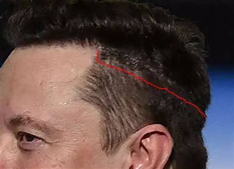 Did Elon Musk Undergo A Hair Transplant? | Fabbon