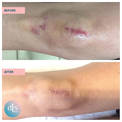 Laser Scar Revision - Denver Laser Solutions