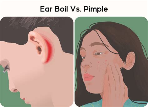 Ear Boil Vs. Pimple: What are the Differences? – Bebird