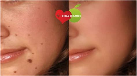 Elimine as Verrugas, as Manchas e a Acne Fazendo isso a Noite | Dicas ...