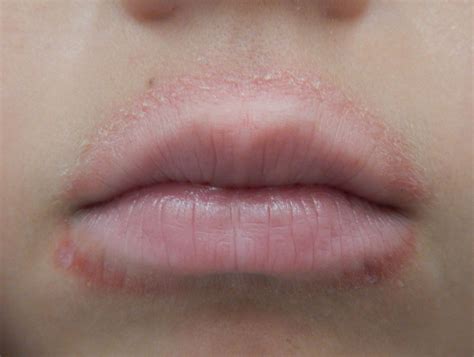 Causes and Treatments for a Rash Around the Mouth (With Pictures) | HealDove