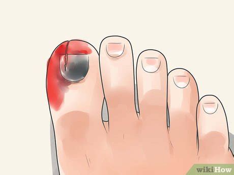 How to Treat a Stubbed Toe: 14 Steps (with Pictures) - wikiHow