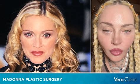 Madonna Plastic Surgery: Before and After Through the Years