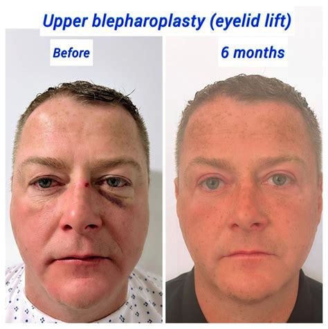 How Long Does Swelling Last After Eyelid Surgery? - Harley Clinic