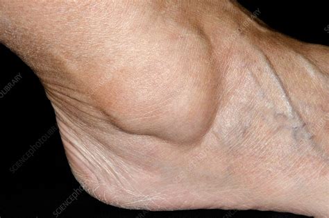 Ganglion over the ankle - Stock Image - C014/2748 - Science Photo Library