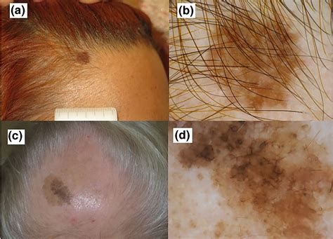 Bestway Melanoma Symptoms Signs Diagnosis Staging Pro - vrogue.co