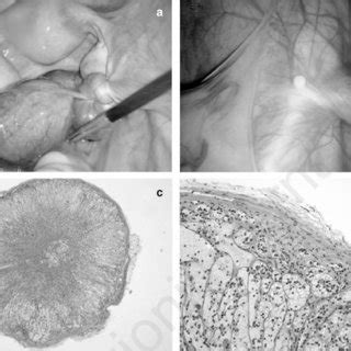 a) Hydrosalpinx; b) ectopic adrenocortical nodule in the left... | Download Scientific Diagram