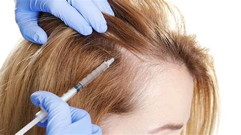 How Effective is Stem Cell Therapy for Hair Loss?