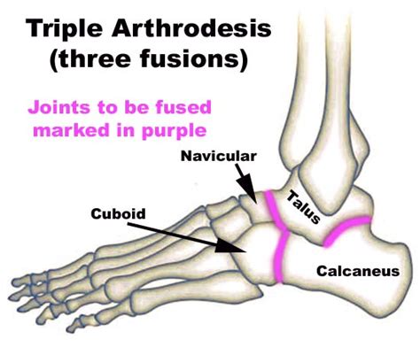 Enjoy the life: Triple Arthrodesis