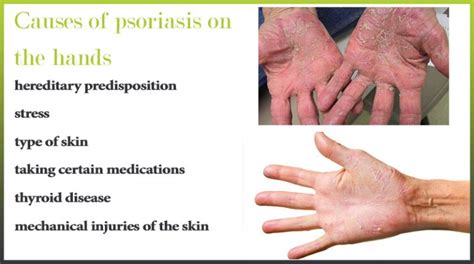 Psoriasis on the hands and palms | Psoriasis expert