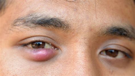 Can stye, pimple or eyelid bumps make your eyes critically ill? Experts ...