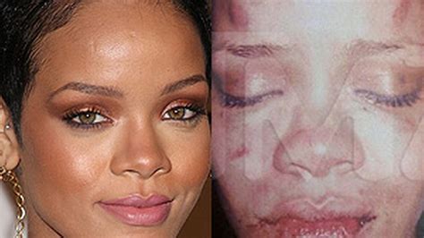 Rihanna's battered face: Leaked picture shows injuries after alleged ...