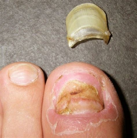 👉 Toenail Falling Off - Symptoms, Causes and Treatment (December 2021)