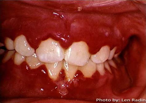 necrotizing periodontal diseases - pictures, photos