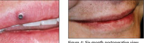 senile hemangioma of lip | Semantic Scholar